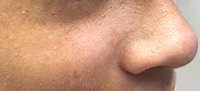Basal cell carcinomas in a child with Basal Cell nevus syndrome
